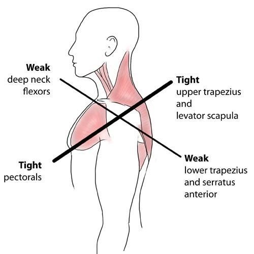 Best pillow for upper cross syndrome hotsell